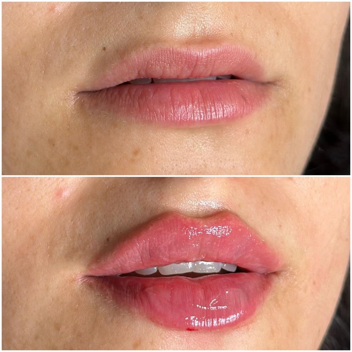 lip fillars regina